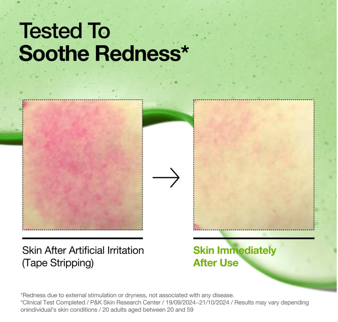 ANUA-Azelaic Acid 10 Hyaluron Redness Soothing Serum