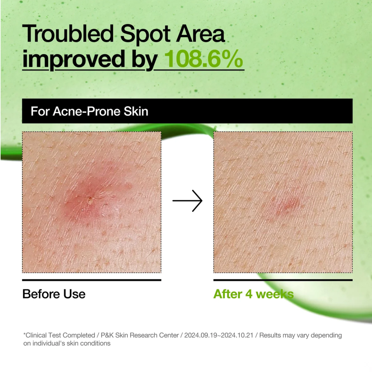 ANUA-Azelaic Acid 10 Hyaluron Redness Soothing Serum